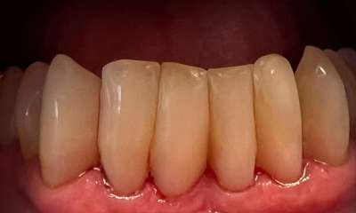 After treatment - Bioclear Composites