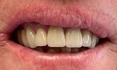 After treatment - Cosmetic Crowns