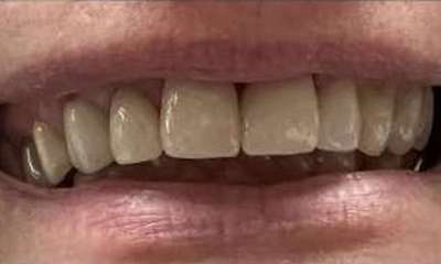 After treatment - Cosmetic Crowns