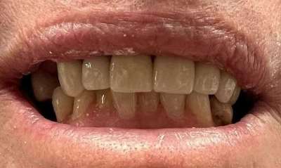 After treatment - Crowns