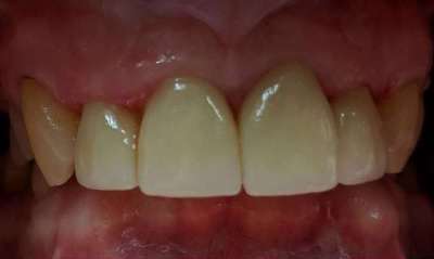 After treatment - Crowns