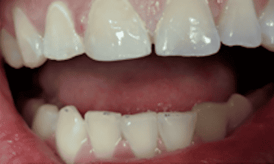 After treatment - Composite Tooth-Colored Filling