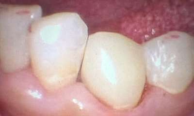 After treatment - Fillings