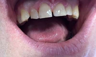 After treatment - Fillings