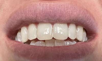After treatment - ICON