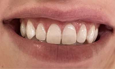 After treatment - ICON