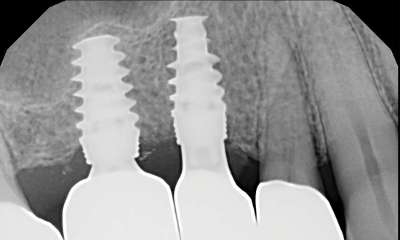 After treatment - Implants