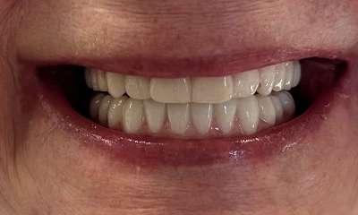 After treatment - Implants