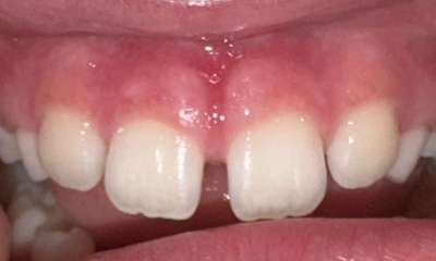 After treatment - Frenectomy/Lip Release