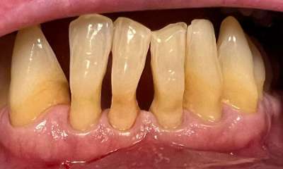 Before treatment - Bioclear Composites