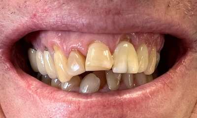 Before treatment - Cosmetic Crowns