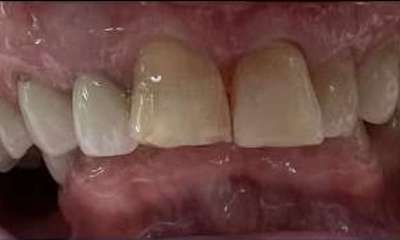 Before treatment - Cosmetic Crowns