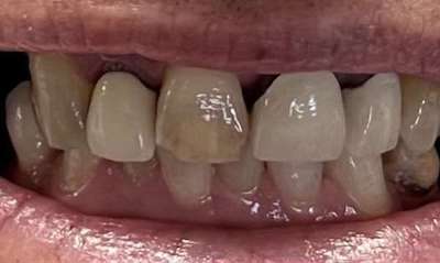 Before treatment - Crowns