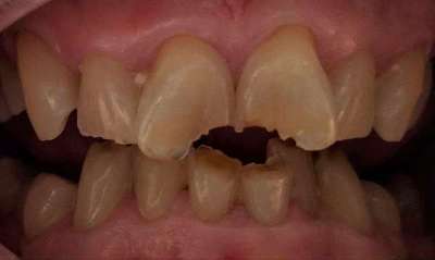 Before treatment - Crowns