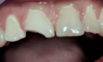 Before treatment - Composite Tooth-Colored Filling