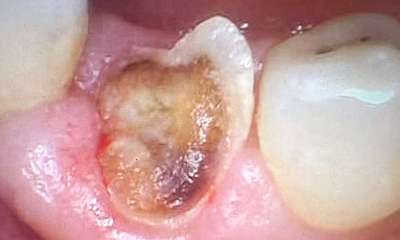 Before treatment - Fillings