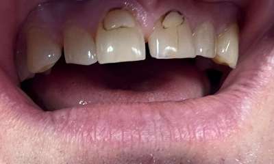 Before treatment - Fillings