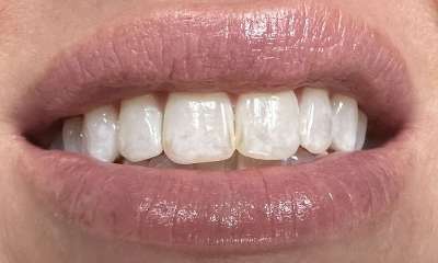 Before treatment - ICON