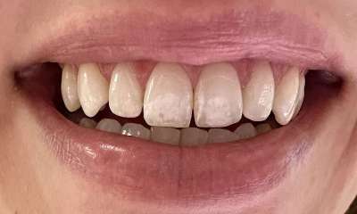 Before treatment - ICON