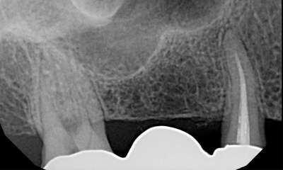 Before treatment - Implants