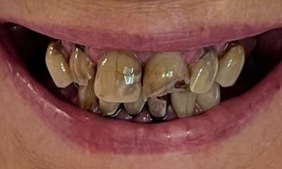 Before treatment - Implants