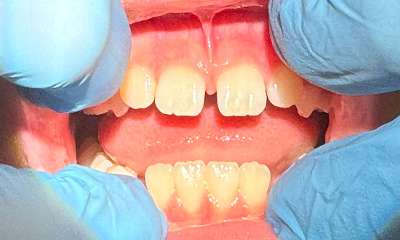 Before treatment - Frenectomy/Lip Release